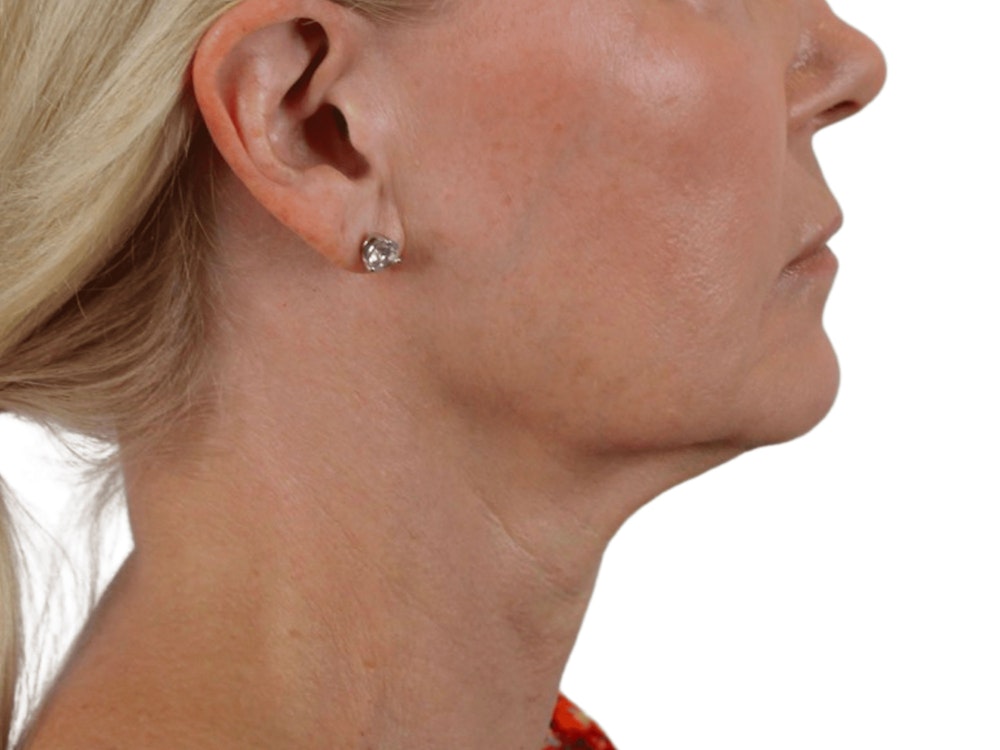 Deep Neck Lift Before & After Gallery - Patient 120947130 - Image 9
