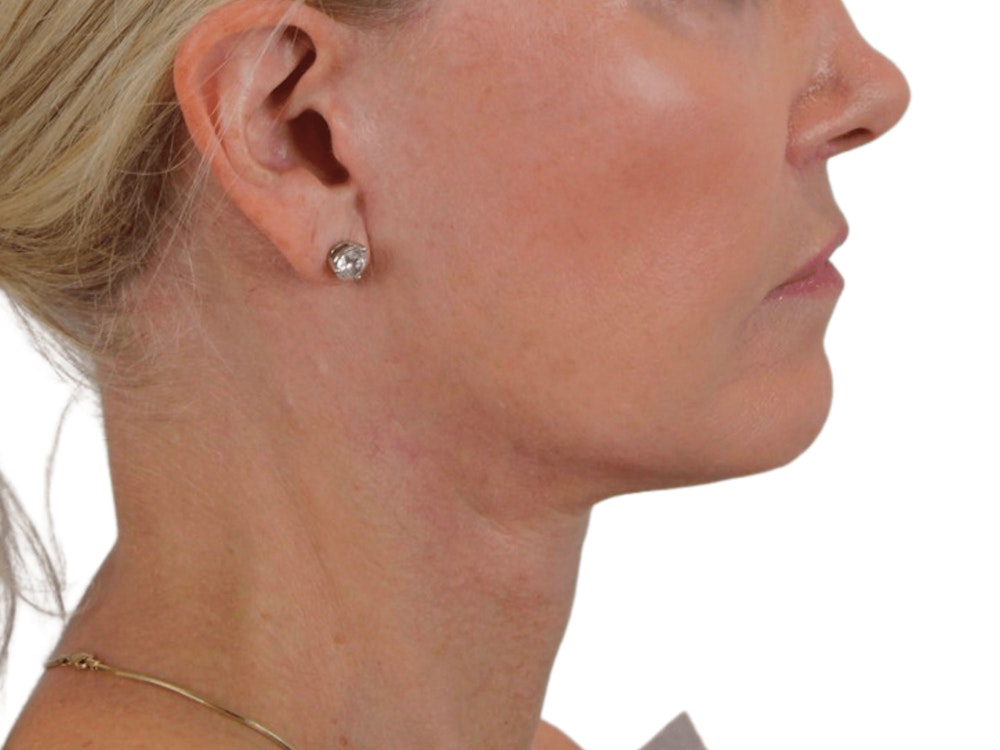 Deep Neck Lift Before & After Gallery - Patient 120947130 - Image 10