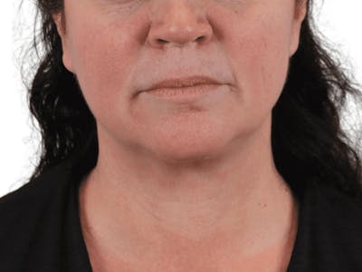 Deep Neck Lift Before & After Gallery - Patient 113523484 - Image 1