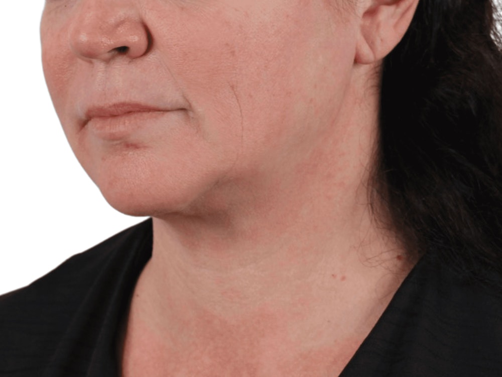 Deep Neck Lift Before & After Gallery - Patient 113523484 - Image 3
