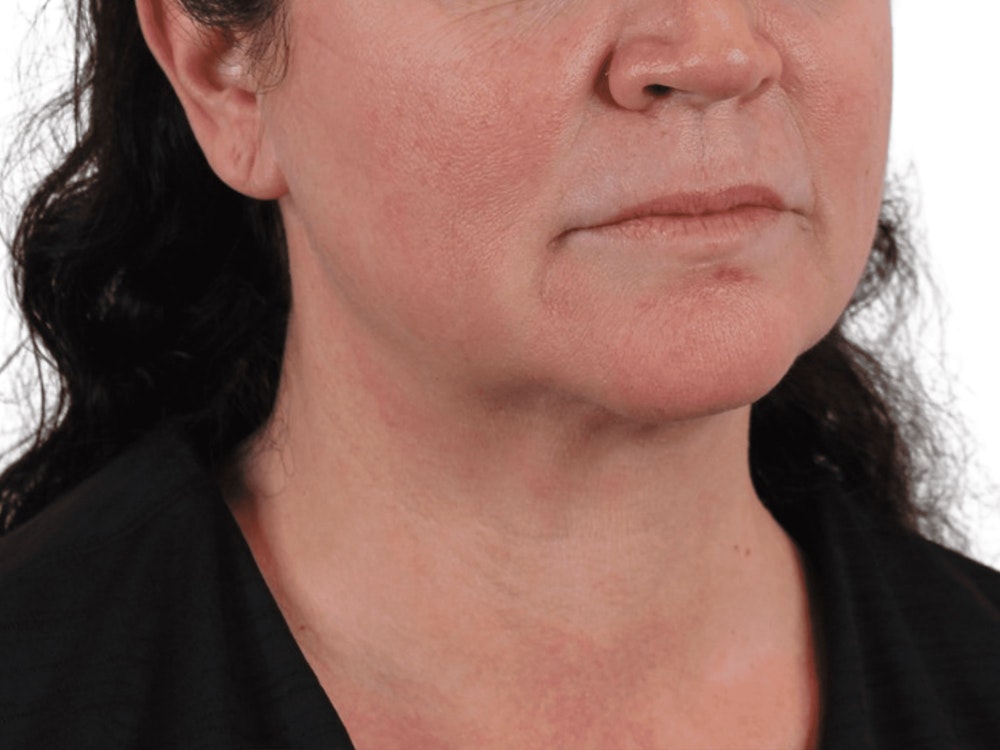 Deep Neck Lift Before & After Gallery - Patient 113523484 - Image 5