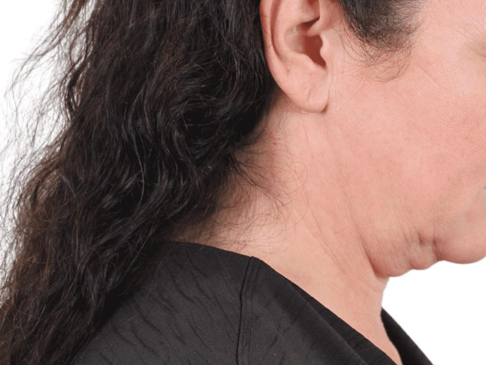 Deep Neck Lift Before & After Gallery - Patient 113523484 - Image 7