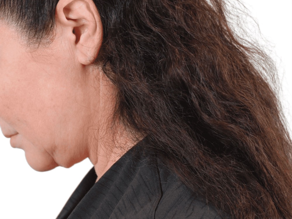 Deep Neck Lift Before & After Gallery - Patient 113523484 - Image 9