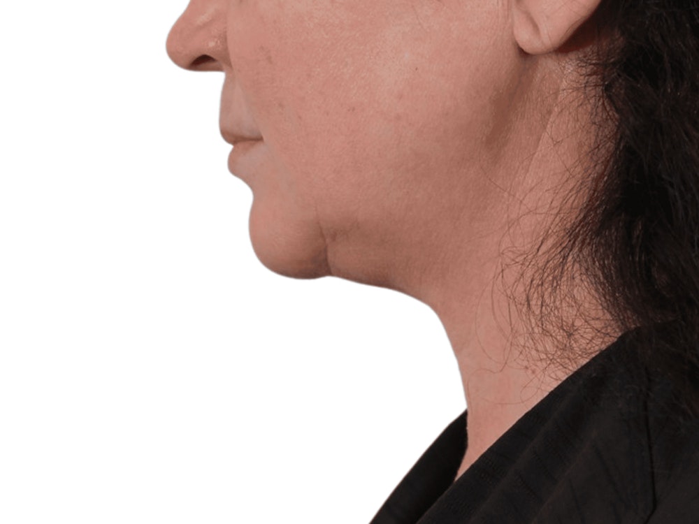 Deep Neck Lift Before & After Gallery - Patient 113523484 - Image 11