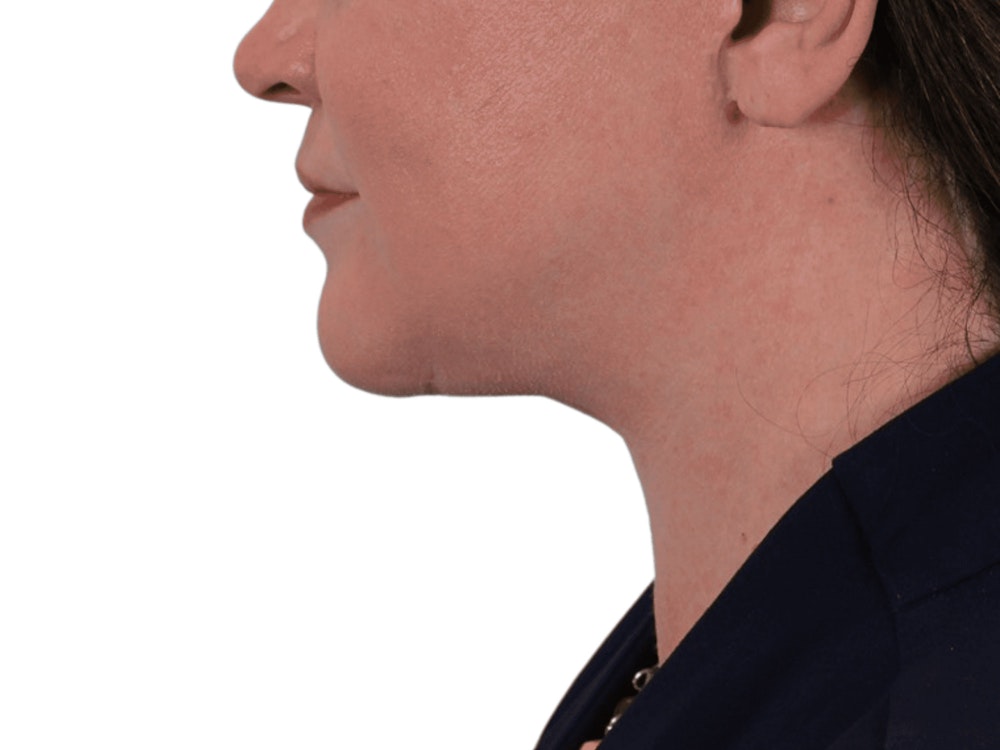 Deep Neck Lift Before & After Gallery - Patient 113523484 - Image 12