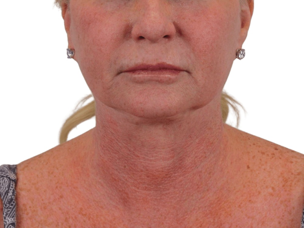 Deep Neck Lift Before & After Gallery - Patient 101059009 - Image 1