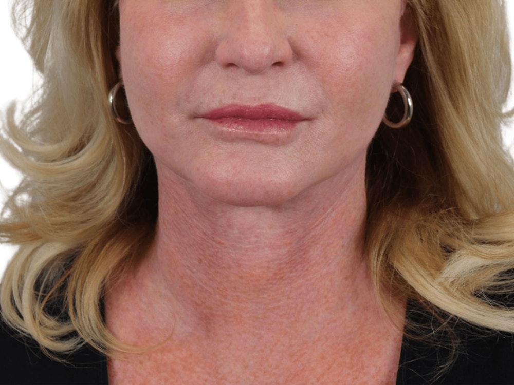 Deep Neck Lift Before & After Gallery - Patient 101059009 - Image 2