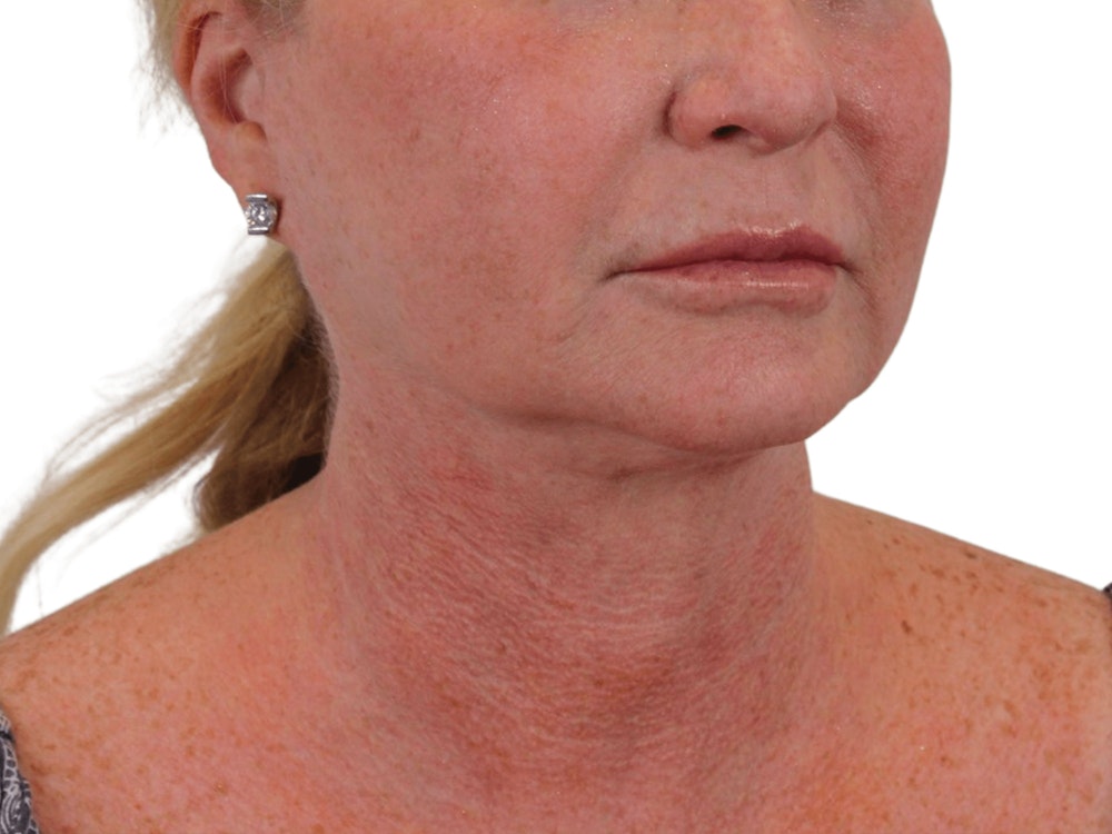 Deep Neck Lift Before & After Gallery - Patient 101059009 - Image 3