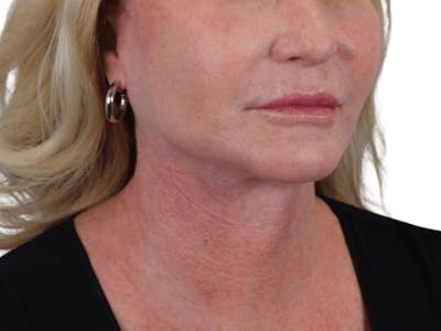 Deep Neck Lift Before & After Gallery - Patient 101059009 - Image 4