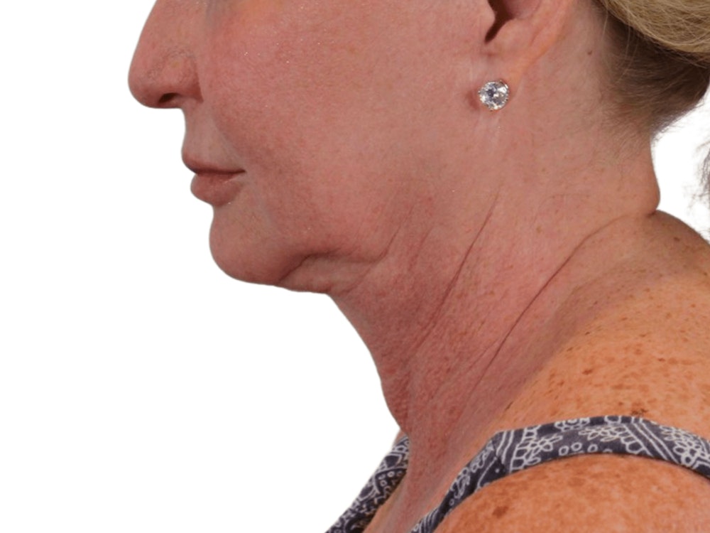 Deep Neck Lift Before & After Gallery - Patient 101059009 - Image 5