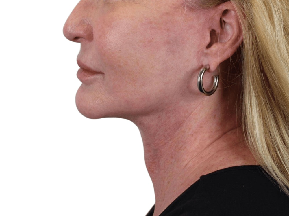 Deep Neck Lift Before & After Gallery - Patient 101059009 - Image 6