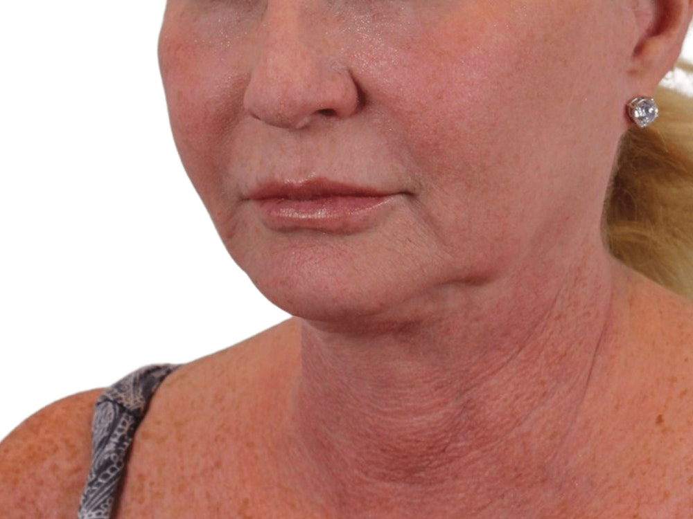 Deep Neck Lift Before & After Gallery - Patient 101059009 - Image 7