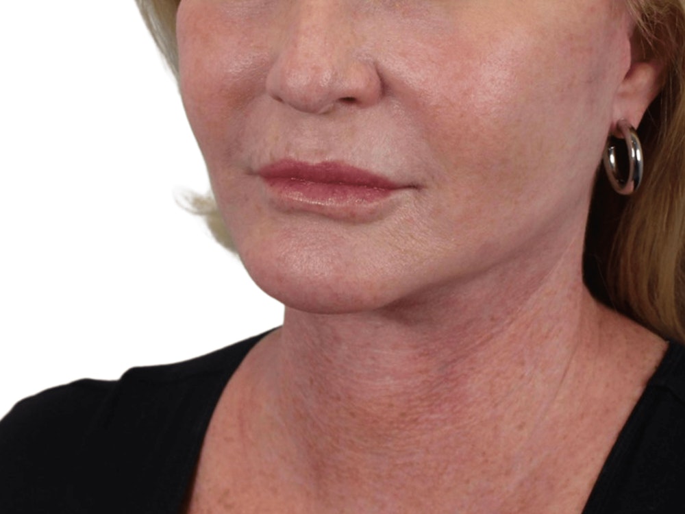 Deep Neck Lift Before & After Gallery - Patient 101059009 - Image 8