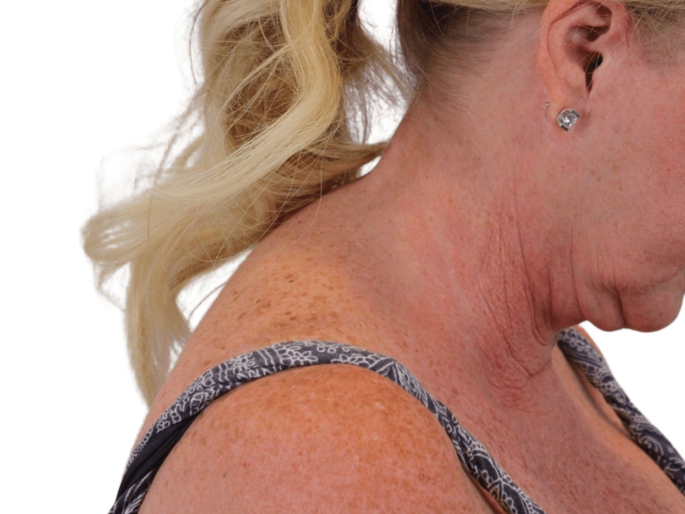 Deep Neck Lift Before & After Gallery - Patient 101059009 - Image 9