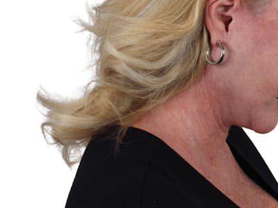 Deep Neck Lift Before & After Gallery - Patient 101059009 - Image 10