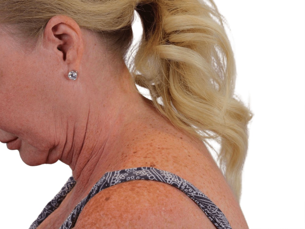 Deep Neck Lift Before & After Gallery - Patient 101059009 - Image 11