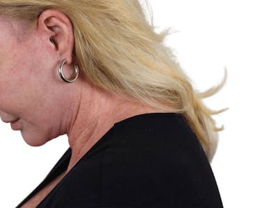 Deep Neck Lift Before & After Gallery - Patient 101059009 - Image 12