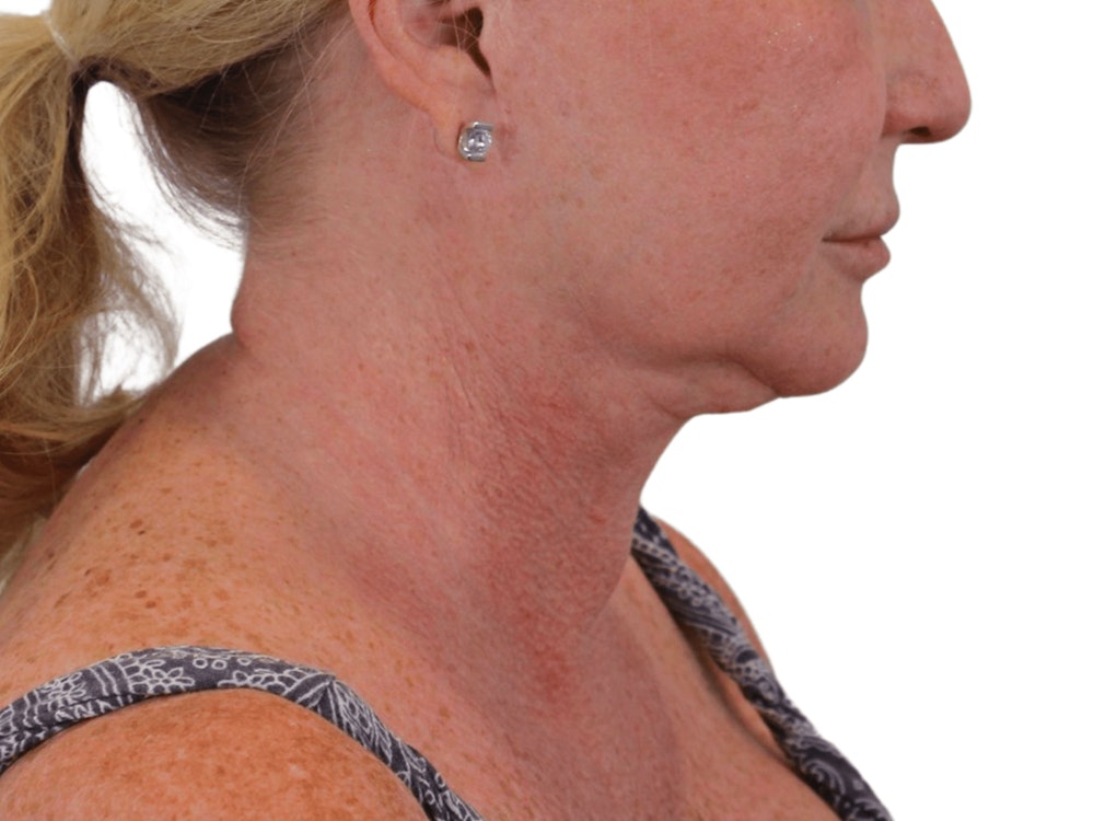 Deep Neck Lift Before & After Gallery - Patient 101059009 - Image 13