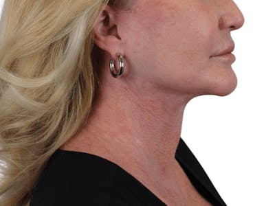 Deep Neck Lift Before & After Gallery - Patient 101059009 - Image 14