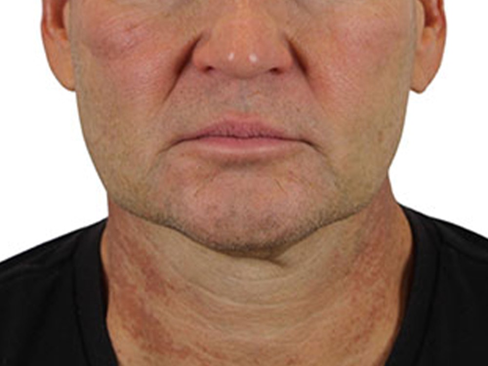 Deep Neck Lift Before & After Gallery - Patient 91738708 - Image 1