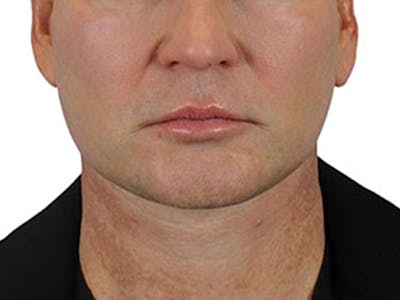 Deep Neck Lift Before & After Gallery - Patient 91738708 - Image 2