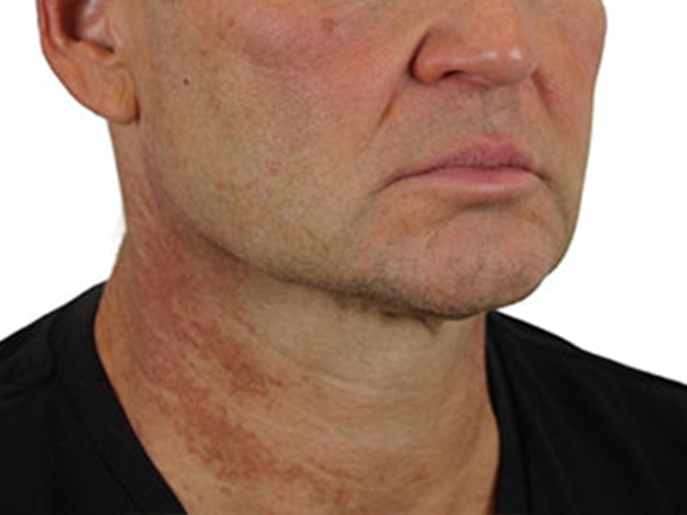Deep Neck Lift Before & After Gallery - Patient 91738708 - Image 3