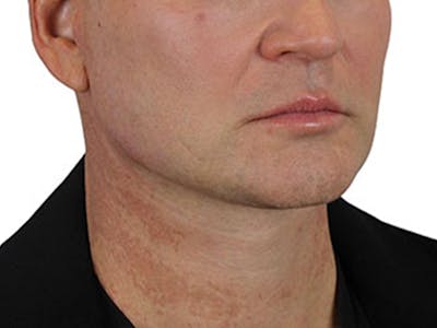 Deep Neck Lift Before & After Gallery - Patient 91738708 - Image 4
