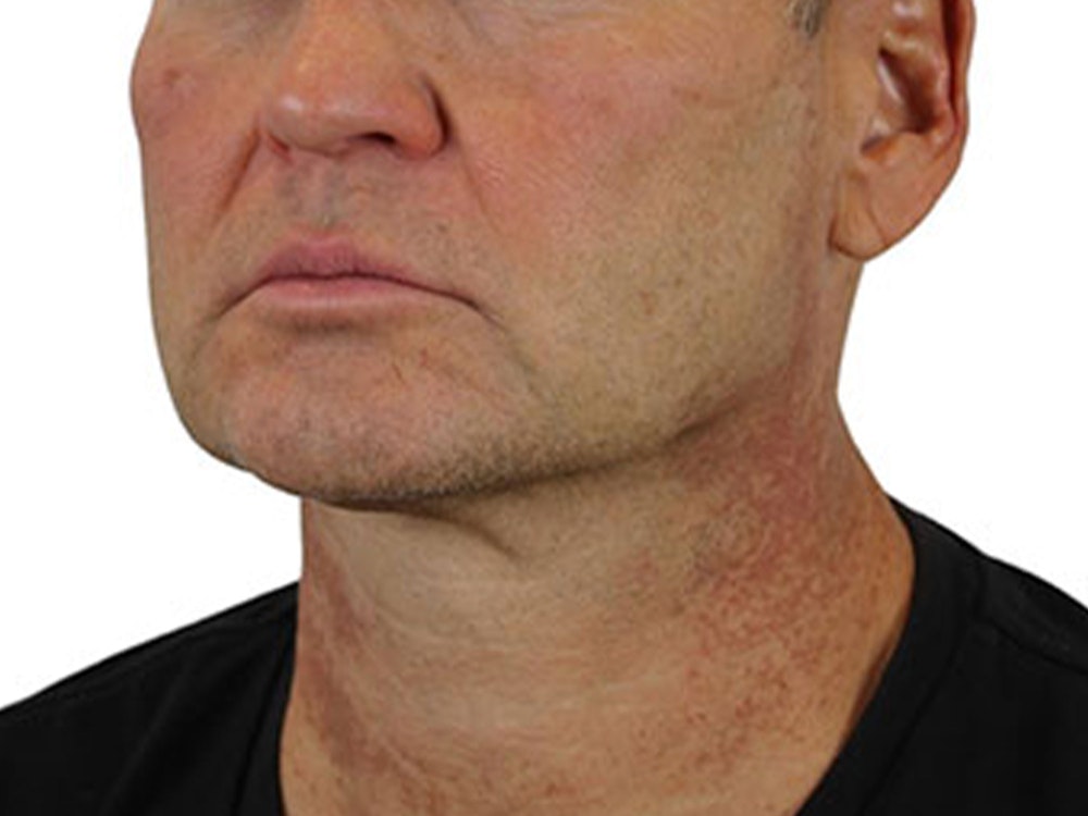 Deep Neck Lift Before & After Gallery - Patient 91738708 - Image 5