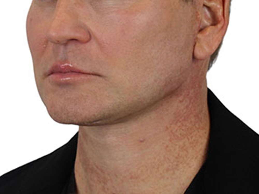 Deep Neck Lift Before & After Gallery - Patient 91738708 - Image 6