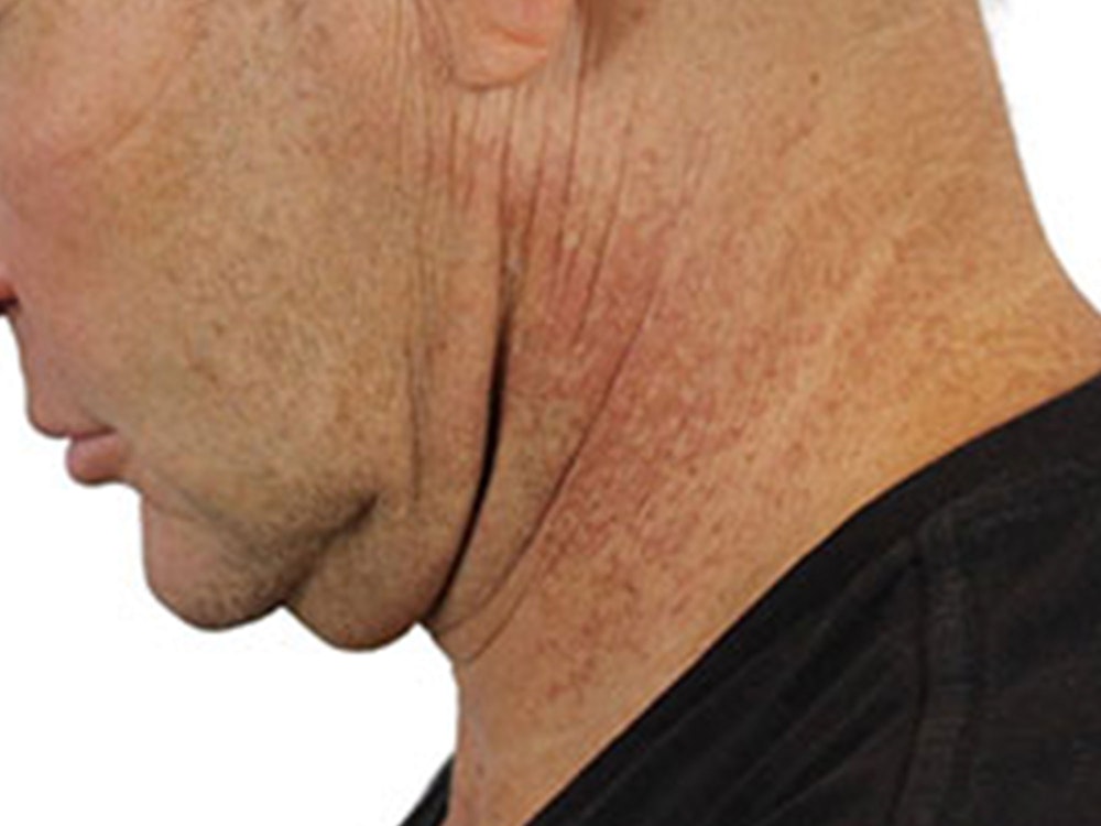 Deep Neck Lift Before & After Gallery - Patient 91738708 - Image 7