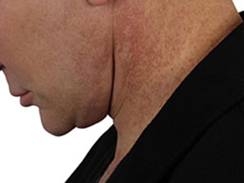 Deep Neck Lift Before & After Gallery - Patient 91738708 - Image 8