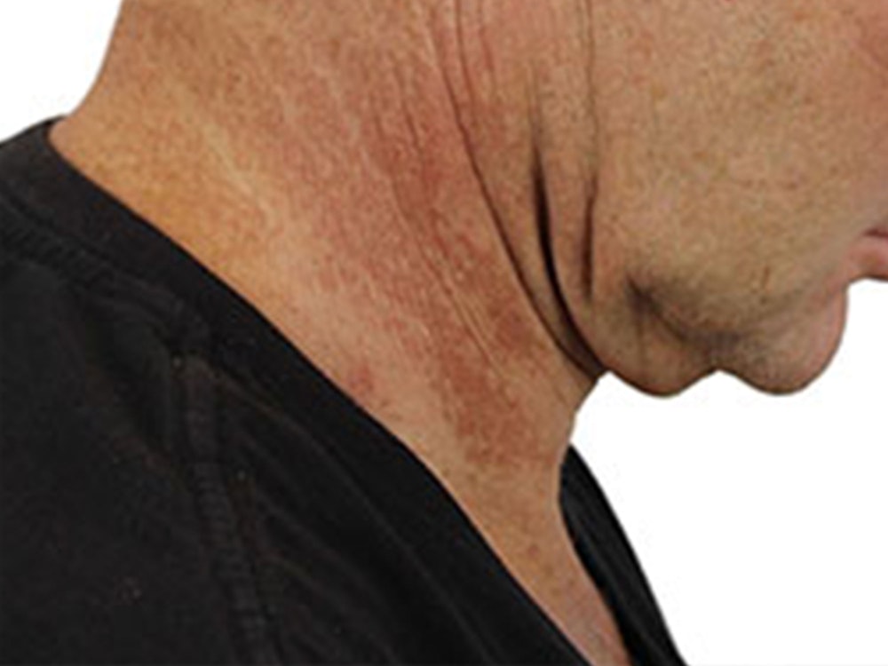 Deep Neck Lift Before & After Gallery - Patient 91738708 - Image 9