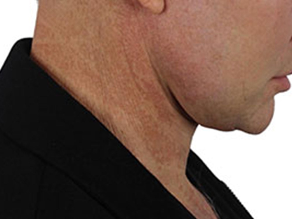Deep Neck Lift Before & After Gallery - Patient 91738708 - Image 10