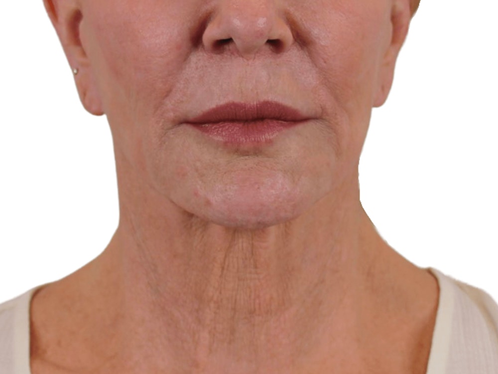 Deep Neck Lift Before & After Gallery - Patient 74223319 - Image 1
