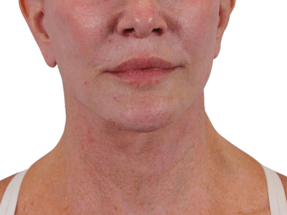 Deep Neck Lift Before & After Gallery - Patient 74223319 - Image 2