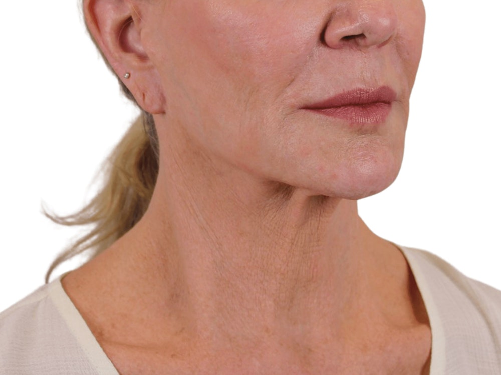 Deep Neck Lift Before & After Gallery - Patient 74223319 - Image 3