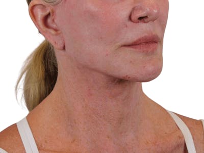 Deep Neck Lift Before & After Gallery - Patient 74223319 - Image 4