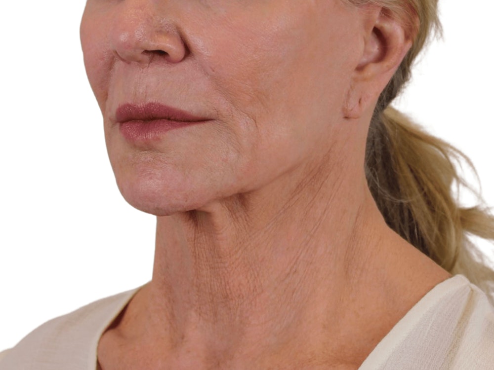 Deep Neck Lift Before & After Gallery - Patient 74223319 - Image 5