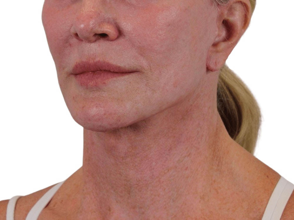 Deep Neck Lift Before & After Gallery - Patient 74223319 - Image 6