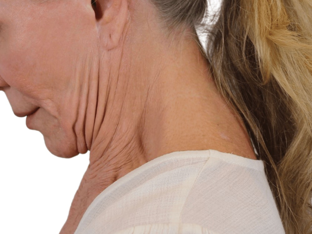 Deep Neck Lift Before & After Gallery - Patient 74223319 - Image 7