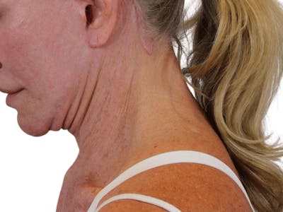Deep Neck Lift Before & After Gallery - Patient 74223319 - Image 8