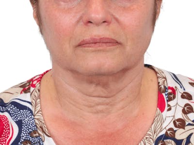 Deep Neck Lift Before & After Gallery - Patient 157358272 - Image 1