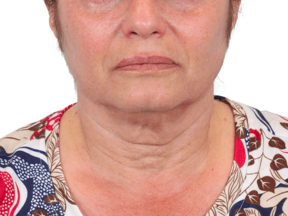 Deep Neck Lift Before & After Gallery - Patient 157358272 - Image 1