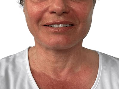 Deep Neck Lift Before & After Gallery - Patient 157358272 - Image 2