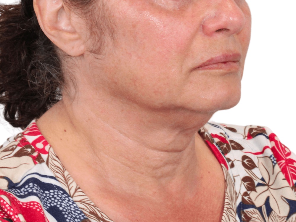 Deep Neck Lift Before & After Gallery - Patient 157358272 - Image 3