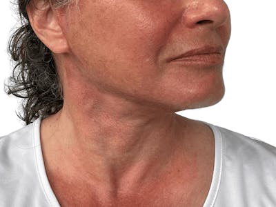 Deep Neck Lift Before & After Gallery - Patient 157358272 - Image 4
