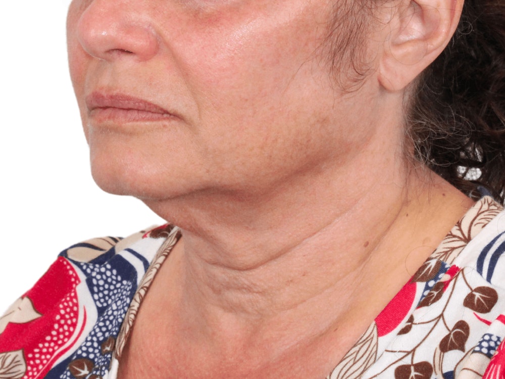 Deep Neck Lift Before & After Gallery - Patient 157358272 - Image 5