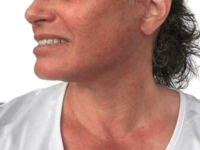Deep Neck Lift Before & After Gallery - Patient 157358272 - Image 6