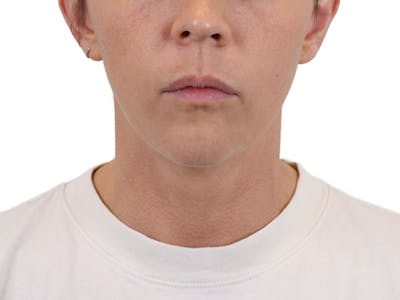 Deep Neck Lift Before & After Gallery - Patient 146130015 - Image 1