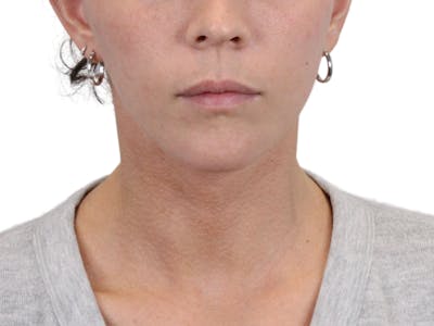 Deep Neck Lift Before & After Gallery - Patient 146130015 - Image 2